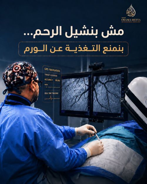 علاج الأورام الليفية بالأشعة التداخلية